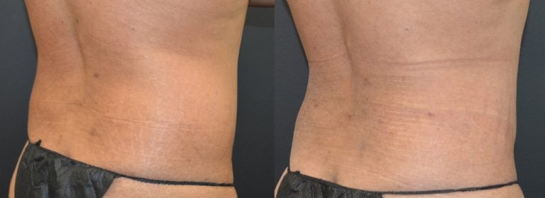 32-year-old-Liposuction-iliac-crests-650-cc-each-side-PAL-6-months-right-oblique
