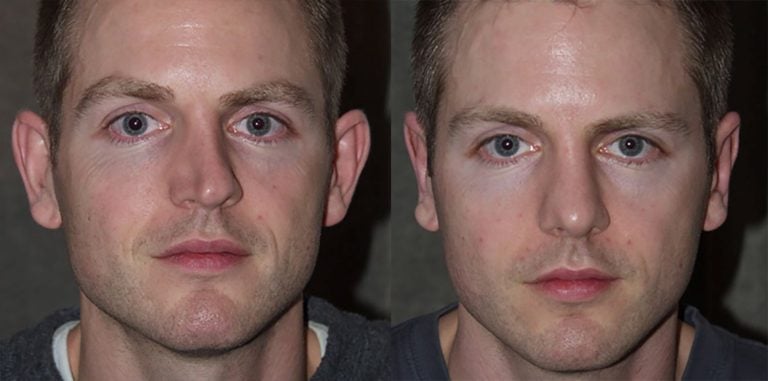 33-year-old-male-bilateral-otoplasty-and-rhinoplasty-with-cartilage-graft-to-nose