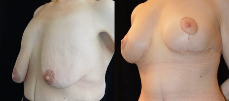 34-year-old-1-month-after-upper-body-lift-and-breast-lift-breast-auto-augmentation-left-oblique-view