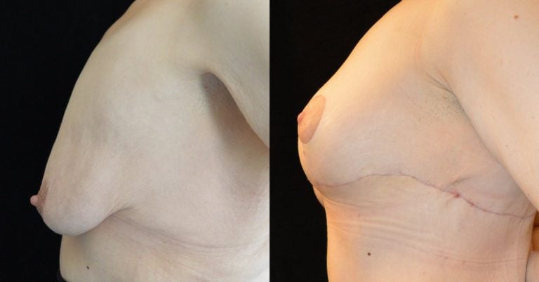 34-year-old-1-month-after-upper-body-lift-and-breast-lift-breast-auto-augmentation-left-side-view