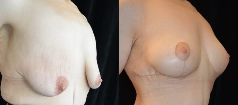 34-year-old-1-month-after-upper-body-lift-and-breast-lift-breast-auto-augmentation-right-oblique-view