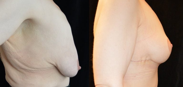34-year-old-1-month-after-upper-body-lift-and-breast-lift-breast-auto-augmentation-right-side-view