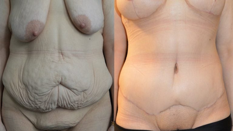 34-year-old-3-months-after-extended-abdominoplasty-and-1-month-after-breast-lift-breast-auto-augmentation-front-view