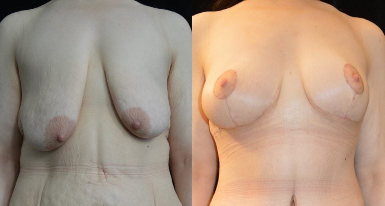 34-year-old-3-months-after-extended-abdominoplasty-and-1-month-after-breast-lift-breast-auto-augmentation-front-view-breasts