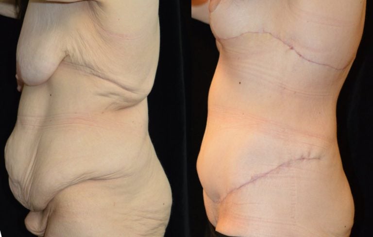34-year-old-3-months-after-extended-abdominoplasty-and-1-month-after-breast-lift-breast-auto-augmentation-left-side-view