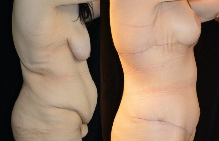 34-year-old, 3 months after extended abdominoplasty and 1 month after breast lift, breast auto augmentation right side view