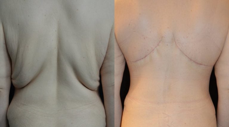 34-year-old female after upper body lift and breast auto-augmentation 1 month