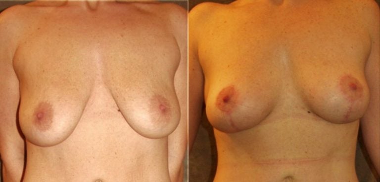 35-year-old-8-months-after-breast-auto-augmentation-front-view