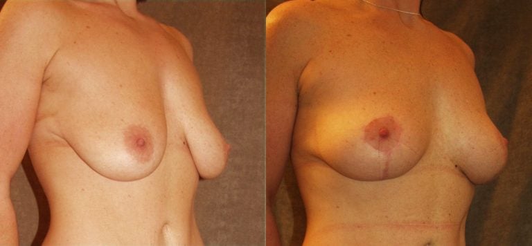 35-year-old-8-months-after-breast-auto-augmentation-oblique-view