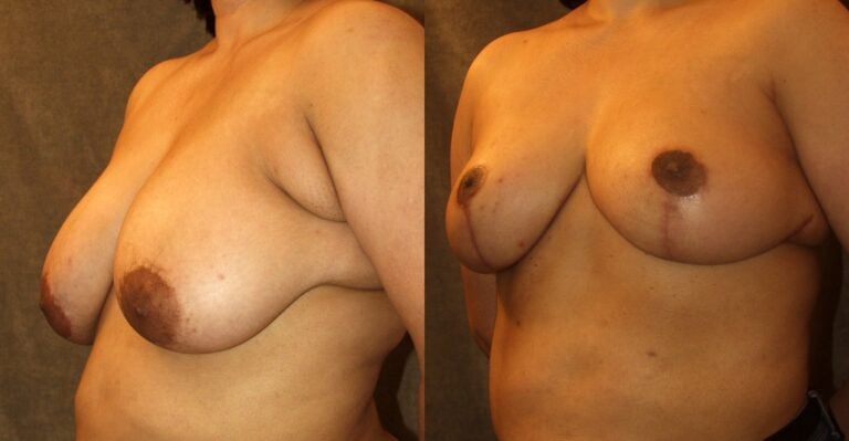 35-year-old-Asian-breast-reduction-axilloplasty-on-left-5-months-left-oblique