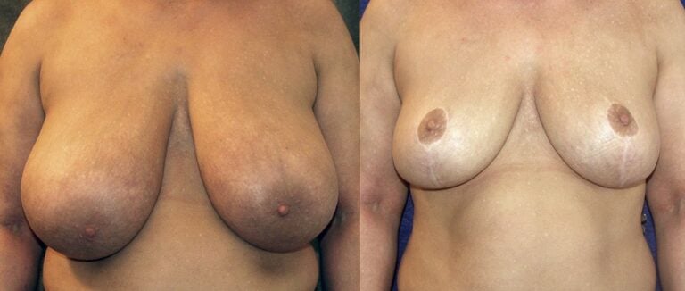 35-year-old-breast-reduction-15-months-front