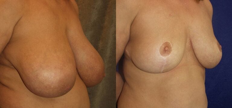 35-year-old-breast-reduction-15-months-right-oblique