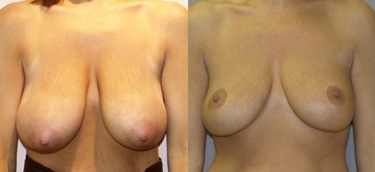 36-year-old-breast-reduction-inferior-pedicle-6-years-front