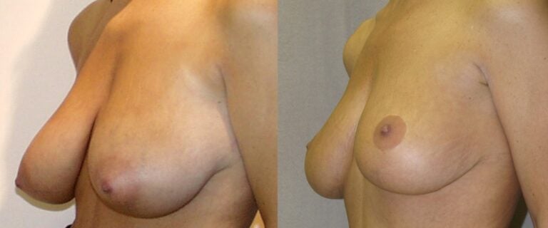 36-year-old-breast-reduction-inferior-pedicle-6-years-left-oblique