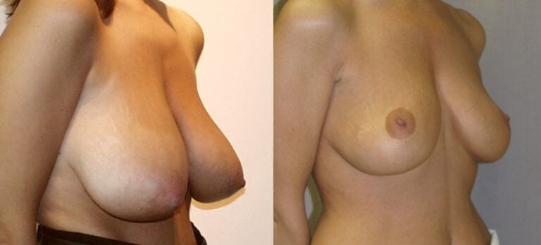 36-year-old-breast-reduction-inferior-pedicle-6-years-right-oblique
