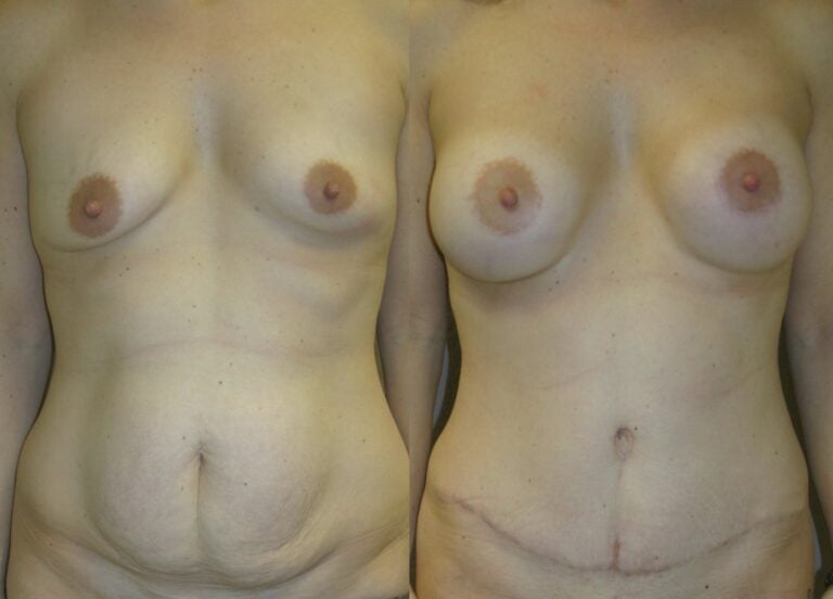 36-year-old-Mommy-Makover-Breast-Augmentation-and-Tummy-Tuck-6-months-after-surgery-front-view