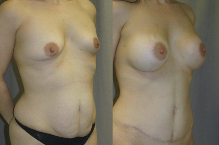36-year-old-Mommy-Makover-Breast-Augmentation-and-Tummy-Tuck-6-months-after-surgery-oblique-view