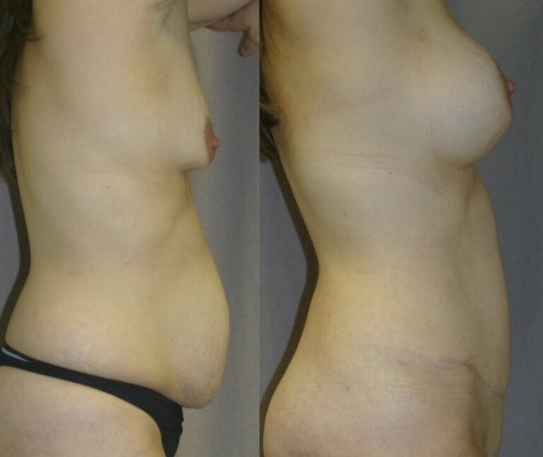 36-year-old-Mommy-Makover-Breast-Augmentation-and-Tummy-Tuck-6-months-after-surgery-side-view