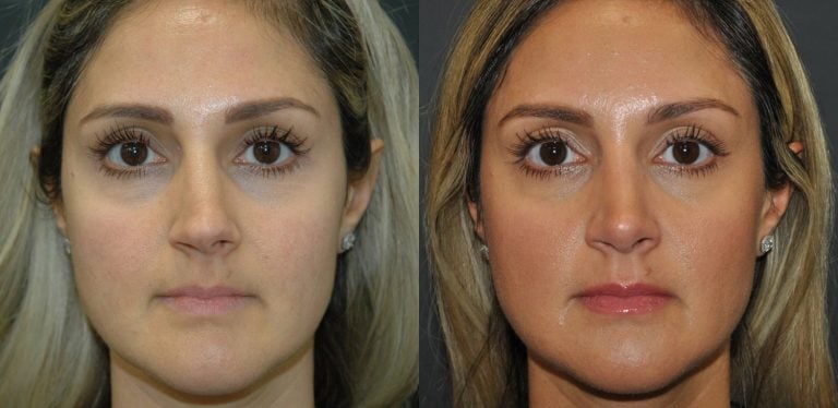 37 year-old open rhinoplasty and septoplasty for crooked nose, 6 months
