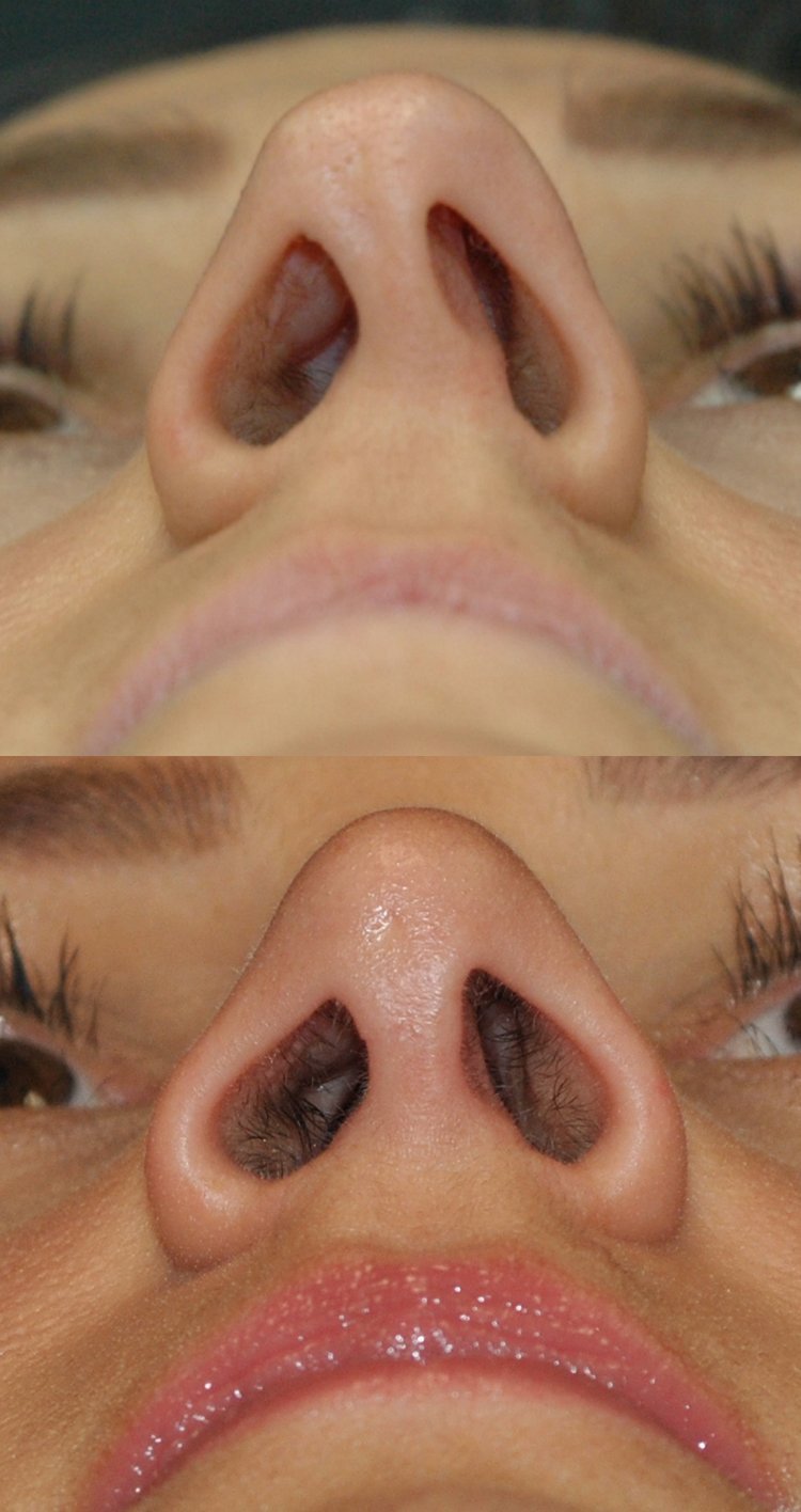 37 year-old open rhinoplasty and septoplasty for crooked nose, 6 months