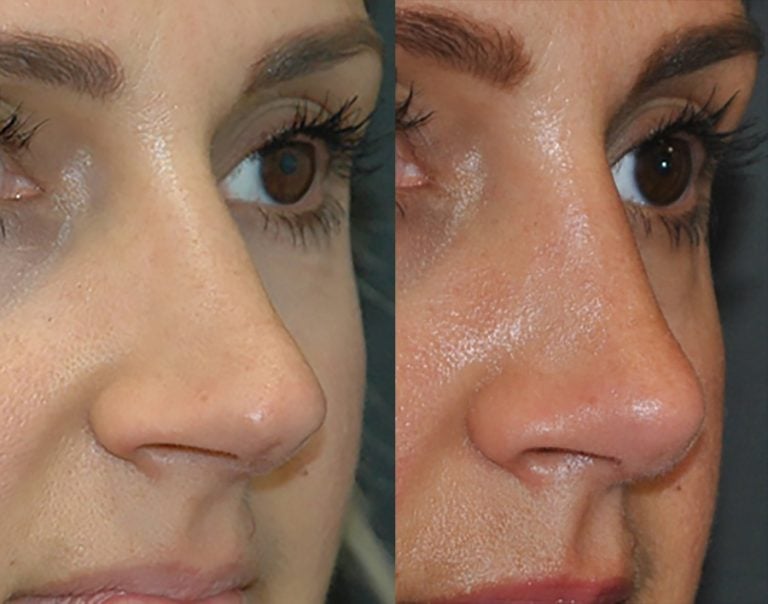 37 year-old open rhinoplasty and septoplasty for crooked nose, close-up oblique, 3 months