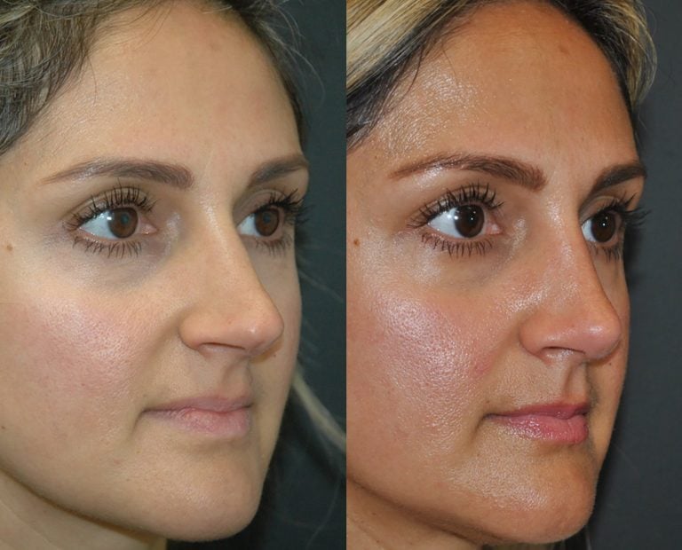 37-year-old-rhinoplasty-and-septoplasty-for-crooked-nose-before-and-after-3-months-oblique 4