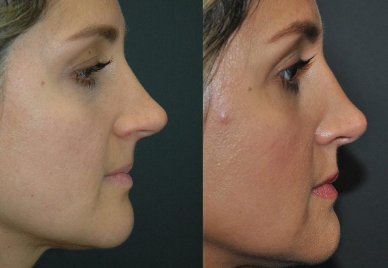 37 year old rhinoplasty and septoplasty for crooked nose before and after 3 months