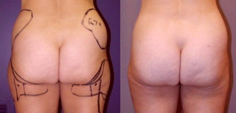 38-year-old 1 year after liposuction hips, inner _ outer thighs, back view