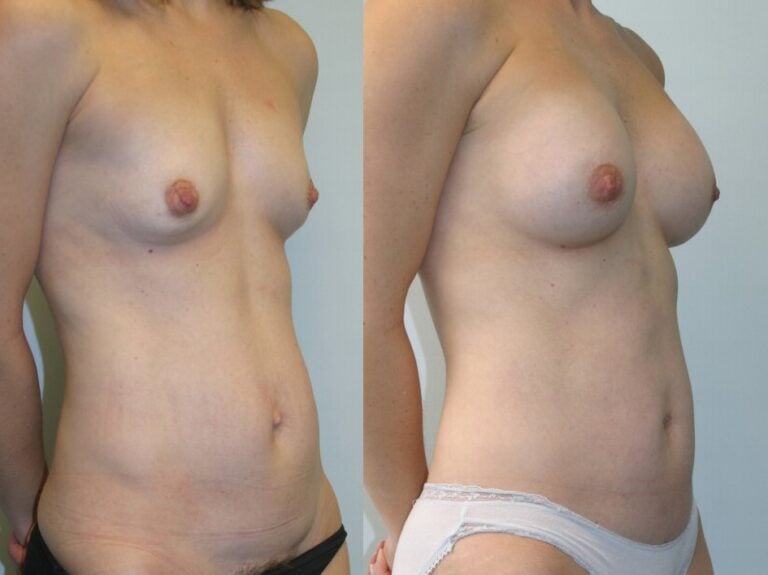 38-year-old-breast-augmentation-modified-abdominoplasty-2-year-oblique