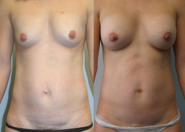 38-year-old-breast-augmentation-modified-abdominoplasty-2-years-front