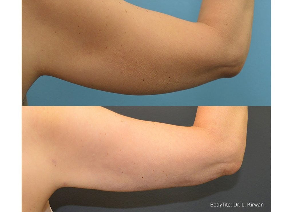 Bodytite Arms