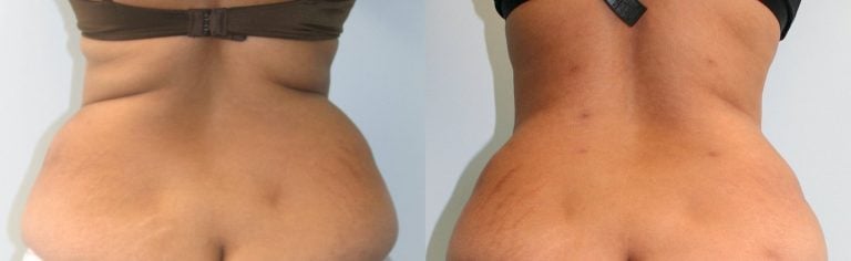 40-year-old-1-year-after-abdominoplasty-and-liposuction-back-and-upper-abdomen-back-view