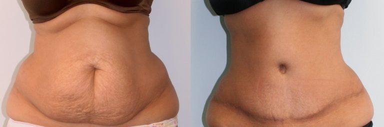 40-year-old-1-year-after-abdominoplasty-and-liposuction-back-and-upper-abdomen-front-view
