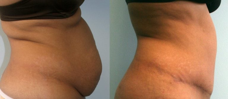 40-year-old-1-year-after-abdominoplasty-and-liposuction-back-and-upper-abdomen-side-view