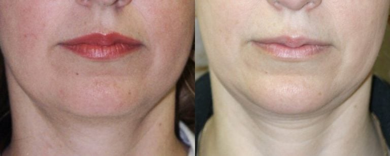 40 year old 2.5 years after chin implant front view