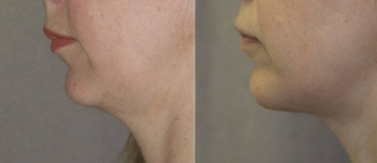 40 year old 2.5 years after chin implant side view 2