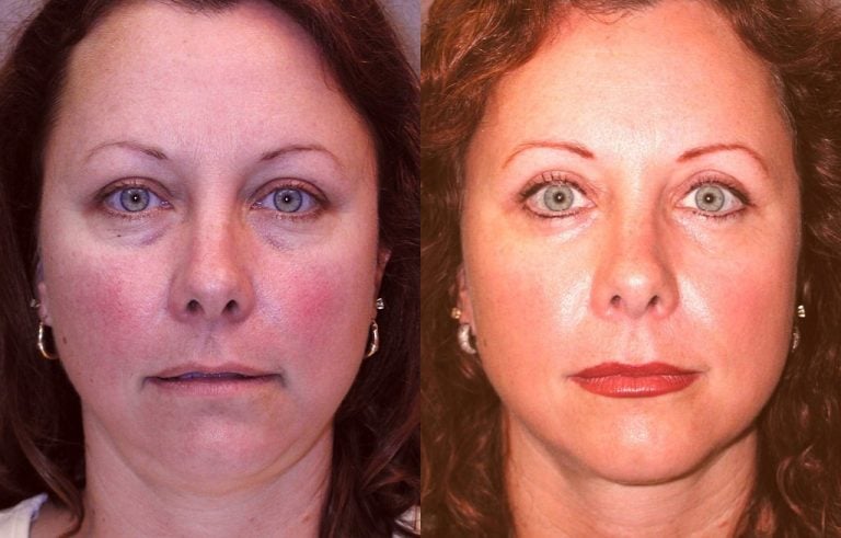 A 40-year-old patient, six weeks after her upper and lower blepharoplasty and submental liposuction procedures