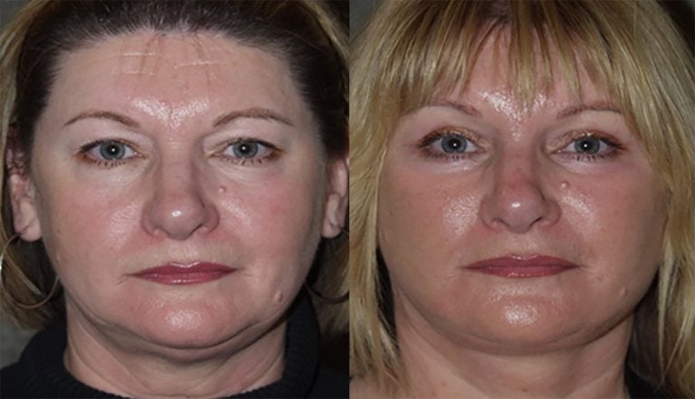 40-year-old-facelift-upper-lower-eyelids-one-year