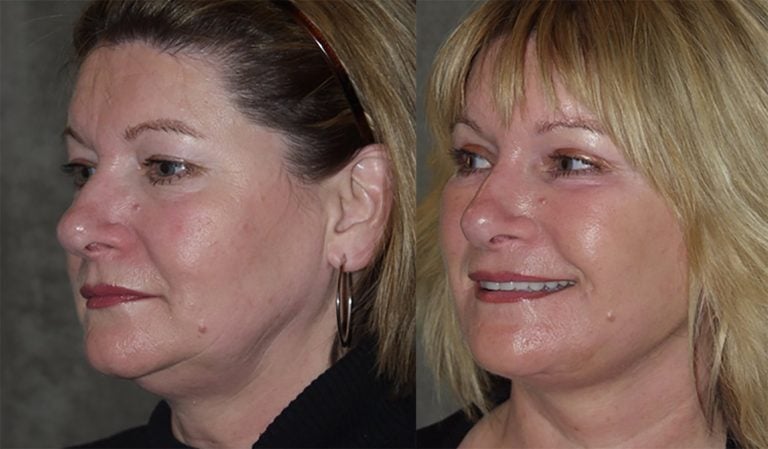 40-year-old-facelift-upper-lower-eyelids-one-year-oblique