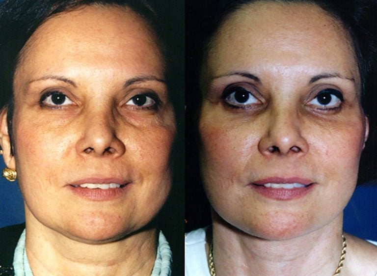 44-year-old-facelift-upper-lower-eyelids-one-year