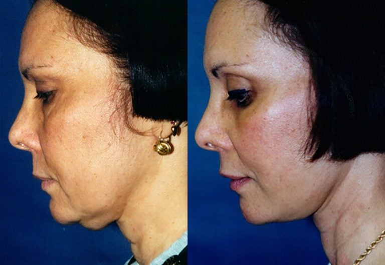 44-year-old-facelift-upper-lower-eyelids-one-year-side-chin-down