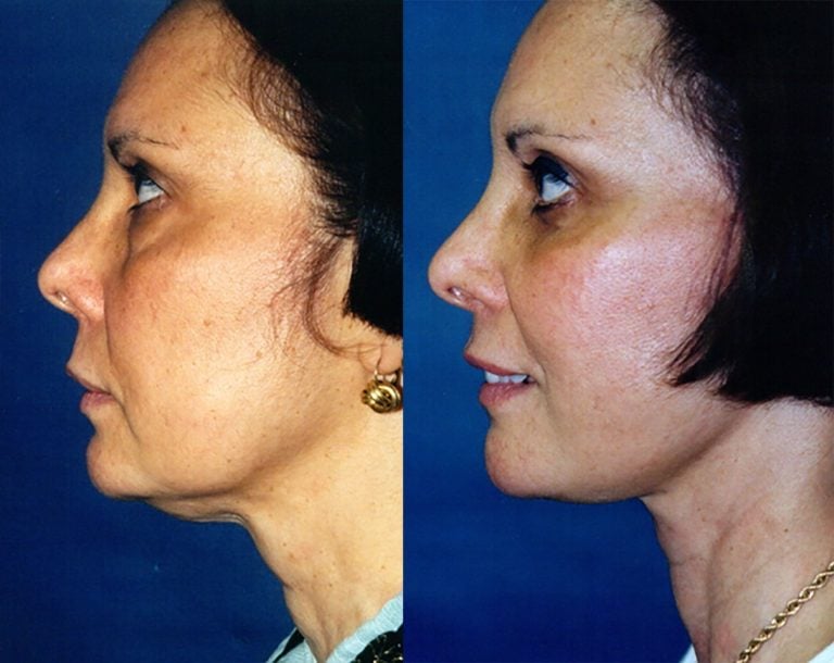 44-year-old-facelift-upper-lower-eyelids-one-year-side-chin-neutral