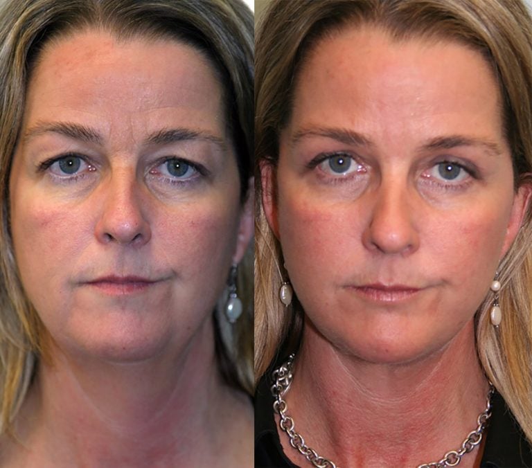 45-year-old-10-months-after-facelift-chin-implant-and-upper-eyelid-blepharoplasty-front