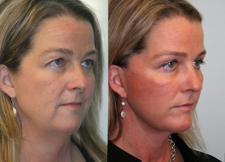 45-year-old-10-months-after-facelift-chin-implant-and-upper-eyelid-blepharoplasty-oblique.