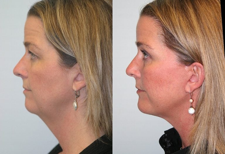 45-year-old-10-months-after-facelift-chin-implant-and-upper-eyelid-blepharoplasty.