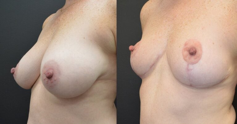 45-year-old-3-months-Right-541-gm-left-586-gm-removal-oblique