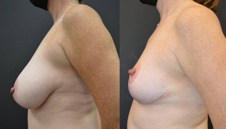45-year-old-3-months-Right-541-gm-left-586-gm-removal-side