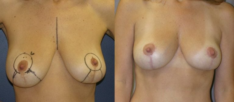 46-year-old-breast-auto-augmentation-7-months-after-surgery-front-view