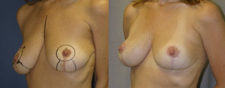 46-year-old-breast-auto-augmentation-7-months-after-surgery-oblique-view