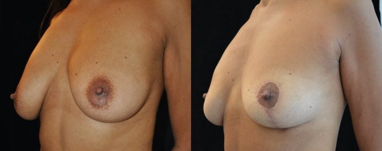 46-year-old-breast-auto-augmentation-8-months-oblique